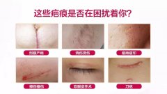祛疤膏哪個牌子好？十款知名度最高的祛疤產(chǎn)品